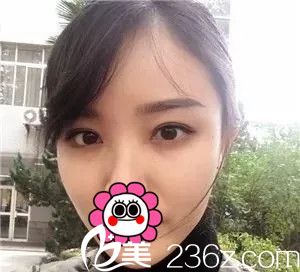 5mm?7mm?9mm? 泰州華美雙眼皮親身體驗告訴你想要自然寬雙眼皮到底選幾毫米合適