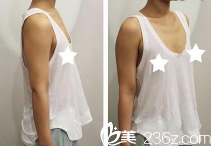 假體隆胸術(shù)前照 假體隆胸術(shù)前照