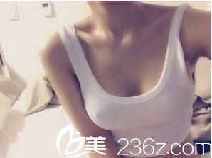 假體隆胸術(shù)后2周效果 假體隆胸術(shù)后2周效果