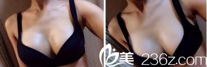 胸部整形術(shù)后1個月效果 胸部整形術(shù)后1個月效果