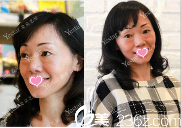 北京藝星醫(yī)療美容醫(yī)院面部脂肪填充術(shù)前照 北京藝星醫(yī)療美容醫(yī)院面部脂肪填充術(shù)前照