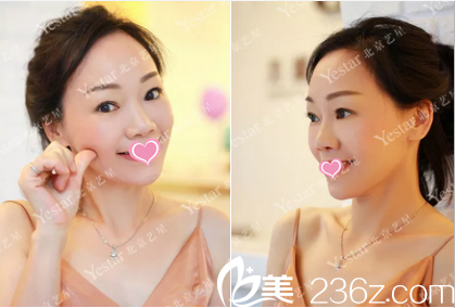 連凱峰面部脂肪填充2月效果 連凱峰面部脂肪填充2月效果