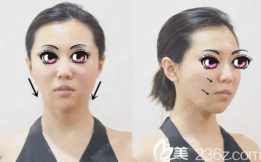 我找<!--<i data=20240703-sp></i>-->做線雕和玻尿酸前 我找<!--<i data=20240703-sp></i>-->做線雕和玻尿酸前