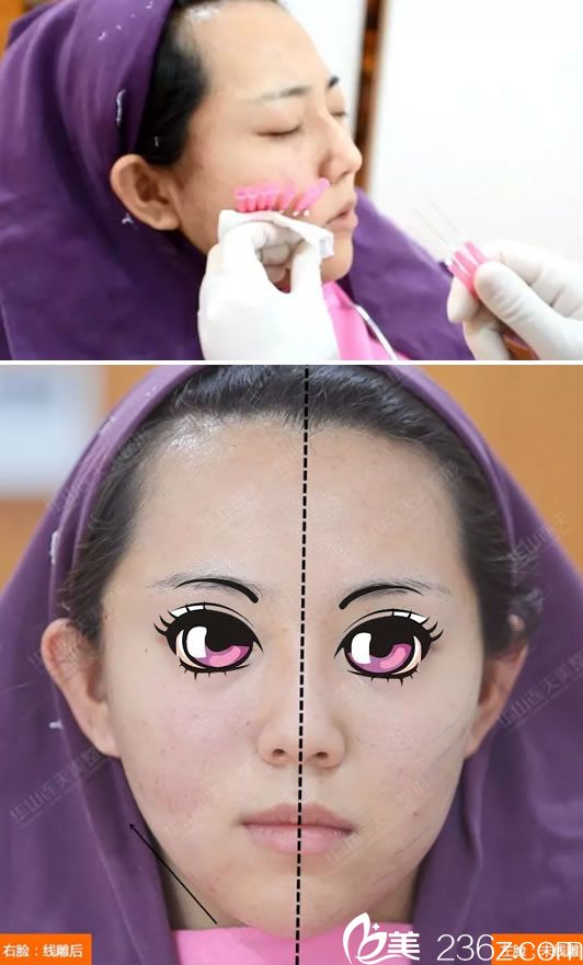 線雕手術(shù)過程和做完半張臉效果 線雕手術(shù)過程和做完半張臉效果