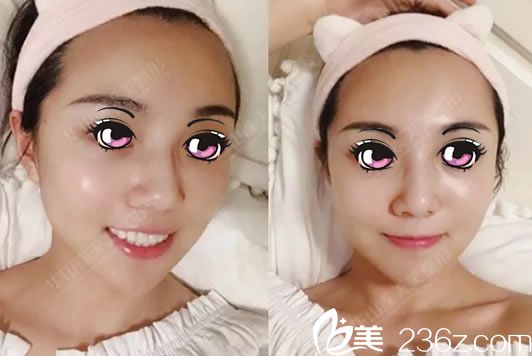 線雕和注射玻尿酸2天恢復(fù)效果 線雕和注射玻尿酸2天恢復(fù)效果