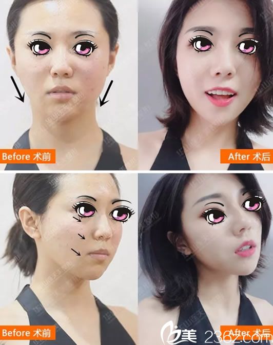 連天美<!--<i data=20240703-sp></i>-->線雕案例對比圖 連天美<!--<i data=20240703-sp></i>-->線雕案例對比圖