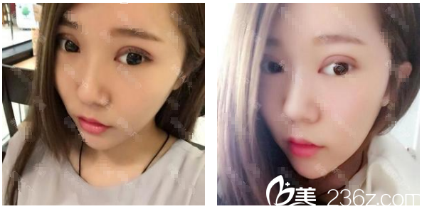 廣州華美阮慶玲雙眼皮天圖片