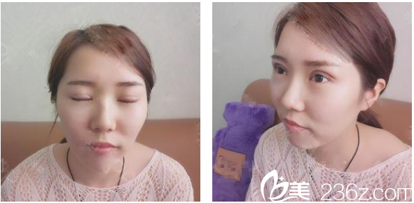 做雙眼皮前看了廣州美萊陳貴宗和田躍平的案例后選擇阮慶玲主任給我做的手術(shù)