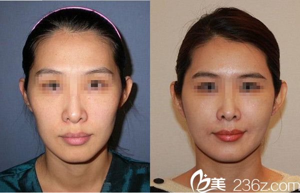 脂肪填充對(duì)比圖 脂肪填充對(duì)比圖