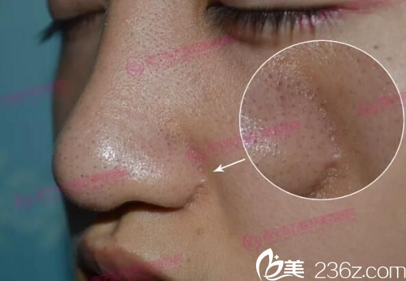 做修復(fù)之前的隆鼻效果