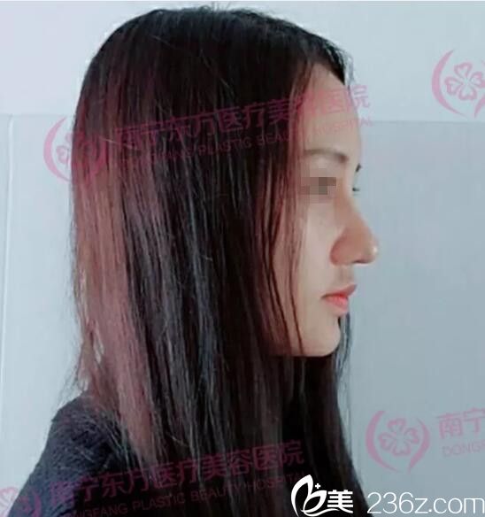 南寧東方整形鼻綜合修復(fù)術(shù)后36天