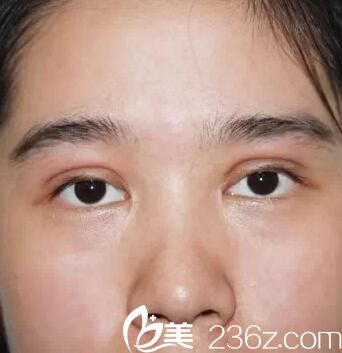 南寧華美雙眼皮術(shù)后第4天