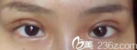 南寧華美雙眼皮術(shù)后第1天