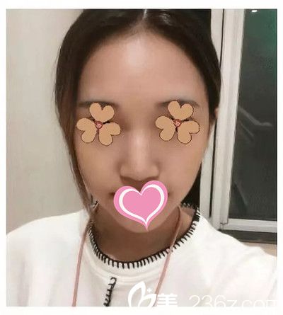 九江臺(tái)美隆鼻案例 九江臺(tái)美隆鼻案例