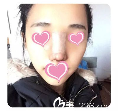 隆鼻后情況 隆鼻后情況