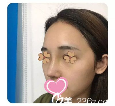 假體隆鼻后一個(gè)月效果 假體隆鼻后一個(gè)月效果