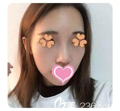 李迎春醫(yī)生隆鼻案例 李迎春醫(yī)生隆鼻案例