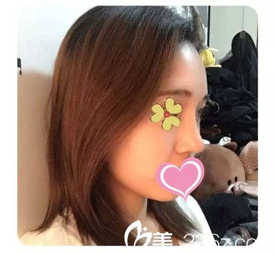 隆鼻后三個(gè)月恢復(fù)效果 隆鼻后三個(gè)月恢復(fù)效果