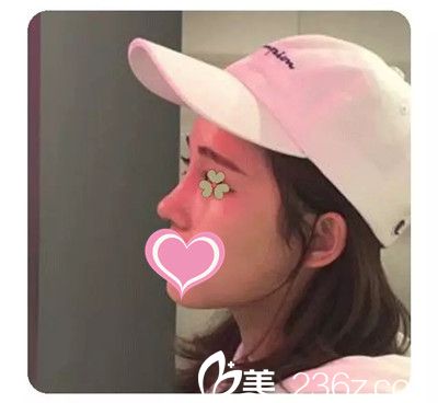 李迎春給我做隆鼻手術(shù)四個(gè)月了 李迎春給我做隆鼻手術(shù)四個(gè)月了