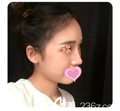 真后悔沒有早點找九江臺美整形李英春醫(yī)生做隆鼻，分享下半年后的蛻變效果吧