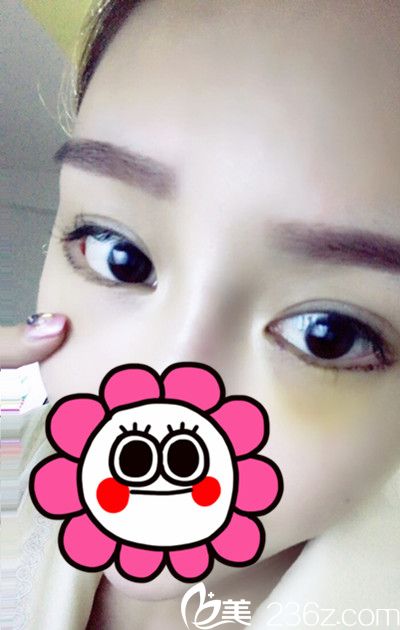 <!--<i data=20240703-sp></i>-->下眼瞼下至手術(shù)后4天