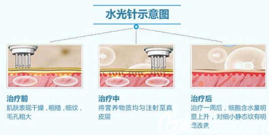 德瑪莎注射原理
