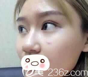 假體隆鼻術(shù)前照 假體隆鼻術(shù)前照