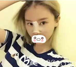 鼻綜合整形當(dāng)天照 鼻綜合整形當(dāng)天照