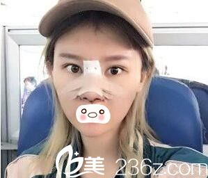 鼻整形術(shù)后5天<span style= 鼻整形術(shù)后5天<span style=