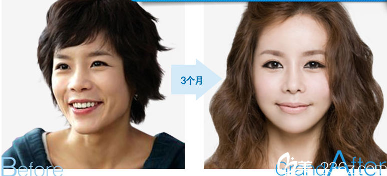 柳相旭院長(zhǎng)雙顎手術(shù) 柳相旭院長(zhǎng)雙顎手術(shù)