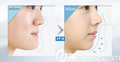 柳相旭院長(zhǎng)雙顎手術(shù)前后對(duì)比 柳相旭院長(zhǎng)雙顎手術(shù)前后對(duì)比