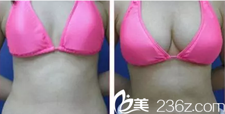 太原歐美蓮自體脂肪隆胸效果圖