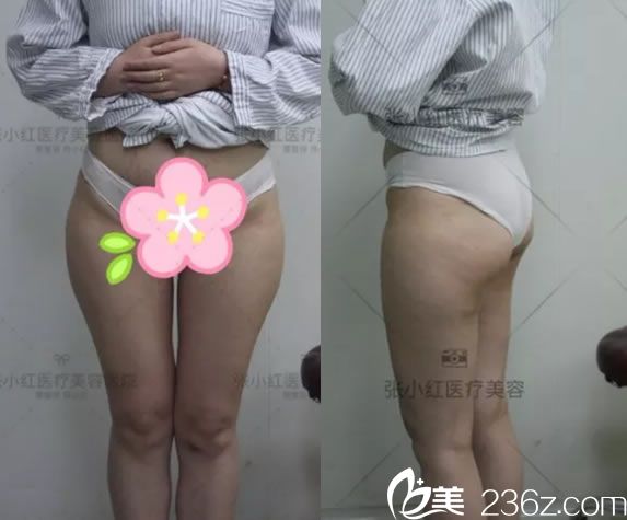 義烏張小紅整形待醫(yī)生做腿部吸脂手術前 義烏張小紅整形待醫(yī)生做腿部吸脂手術前