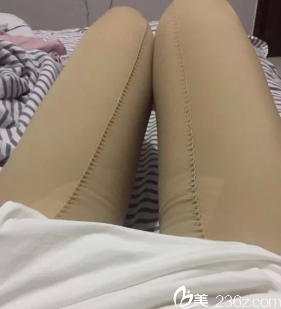 做完大腿和小腿吸脂手術1天效果 做完大腿和小腿吸脂手術1天效果