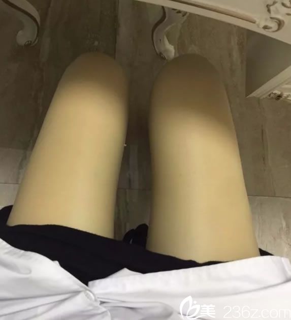 腿部吸脂手術第5天恢復照 腿部吸脂手術第5天恢復照