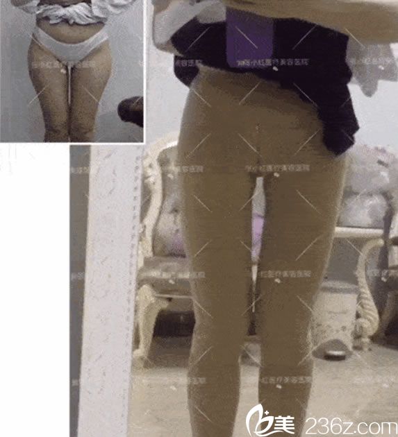 義烏張小紅腿部吸脂案例8天對比圖 義烏張小紅腿部吸脂案例8天對比圖