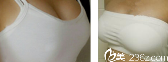 膠假體隆胸第20天恢復(fù)圖片 膠假體隆胸第20天恢復(fù)圖片