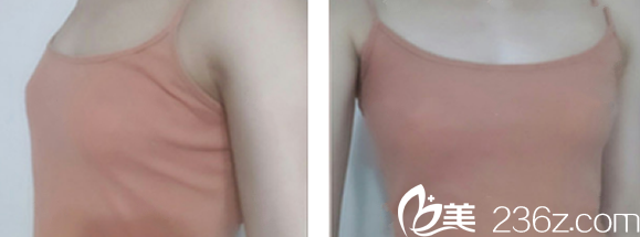 蘭州崔大夫整形隆胸前 蘭州崔大夫整形隆胸前