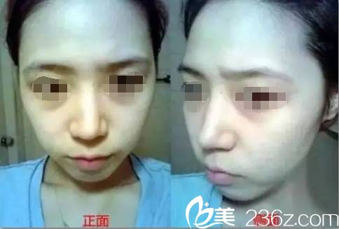 術前面頰凹陷顯老 術前面頰凹陷顯老