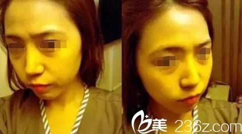 玻尿酸注射填充面部 玻尿酸注射填充面部