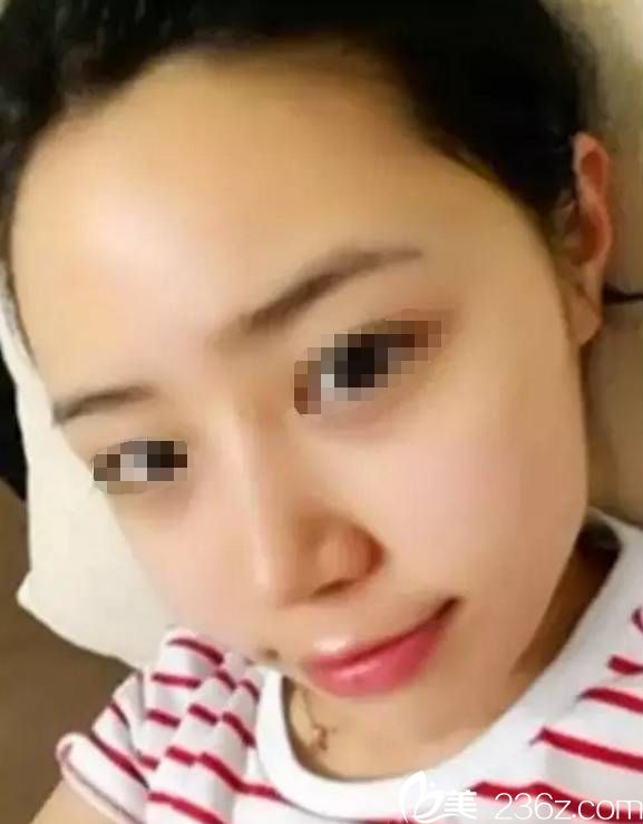 注射玻尿酸填充術后兩天 注射玻尿酸填充術后兩天