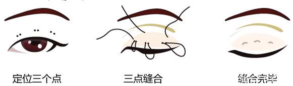 愛思特韓式雙眼皮手術(shù)過程 愛思特韓式雙眼皮手術(shù)過程