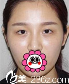 南寧愛思特雙眼皮術(shù)前 南寧愛思特雙眼皮術(shù)前