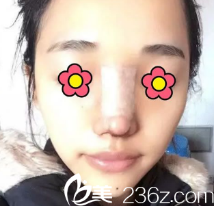 安康蝶姿美容門診部隆鼻天 安康蝶姿美容門診部隆鼻天