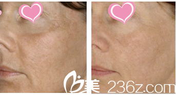 韓國(guó)Stanley皮膚科皮膚美容效果展示 韓國(guó)Stanley皮膚科皮膚美容效果展示