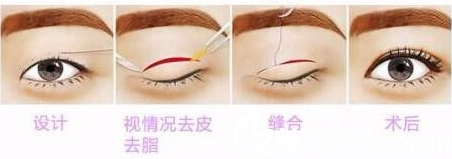 濟源<!--<i data=20240703-sp></i>-->萍全切雙眼皮過程