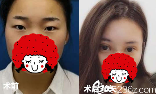 合肥<!--<i data=20240703-sp></i>-->雙眼皮案例效果前后對(duì)比圖 合肥<!--<i data=20240703-sp></i>-->雙眼皮案例效果前后對(duì)比圖