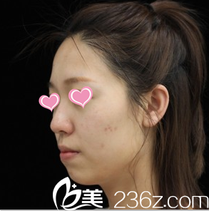 韓國(guó)Stanley皮膚科案例注射之前照 韓國(guó)Stanley皮膚科案例注射之前照