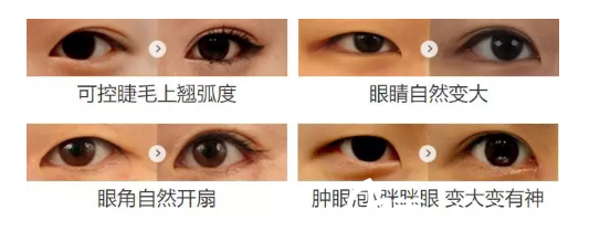 翹睫美瞳術(shù)案例