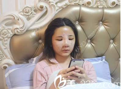 廣州壹加壹李明做的隆鼻脂肪填充術(shù)后第二天